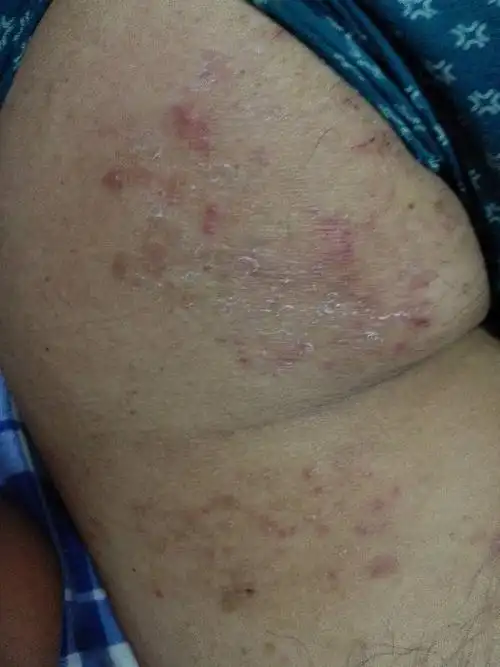 臀部上长小红包,干了会产生白壳,热起来了会很痒,有好些年了,冬天