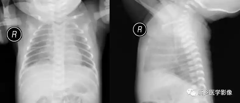新生儿肺纹理粗不一定是肺炎,有可能是:新生儿湿肺
