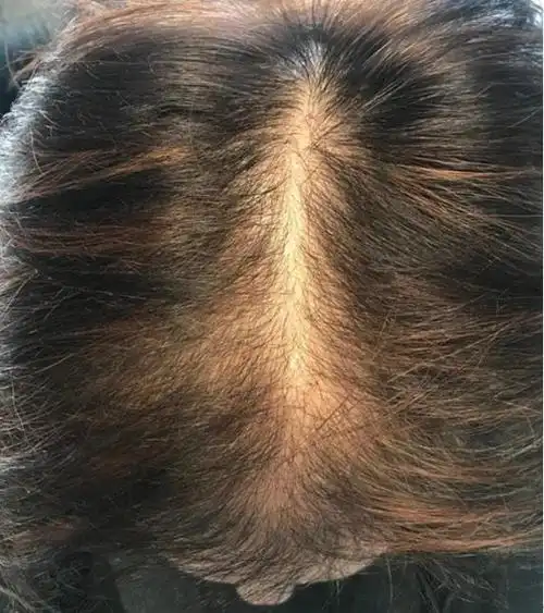 诊断女性型脱发不能看发际线3个小技巧教你鉴别