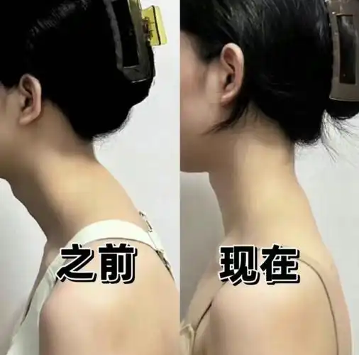 试过了,真的可以改善脖子前倾