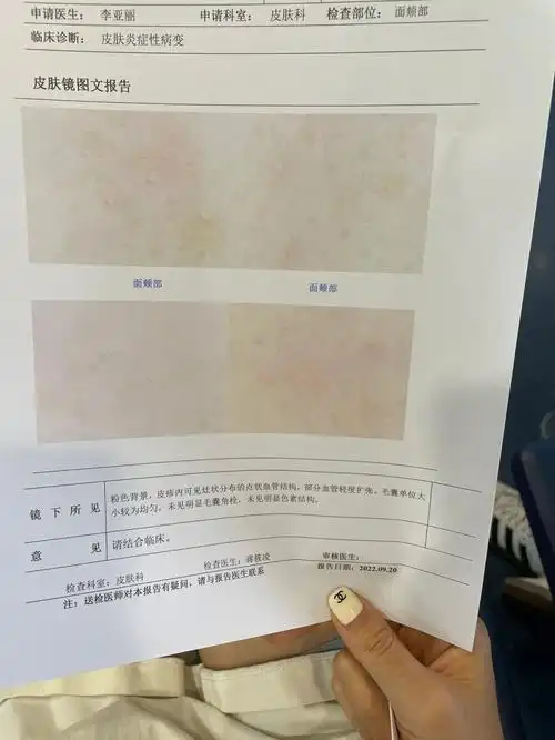 开始新的药罐子西药原本抗过敏的换成控制神经的复方芦丁片清水洗脸