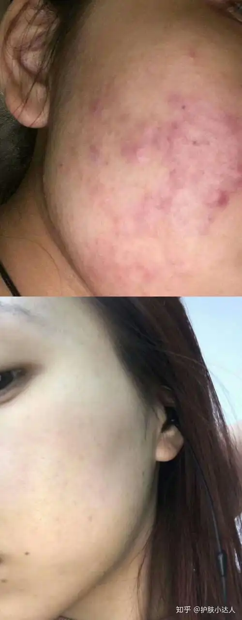 有哪些很神奇的祛痘印产品?