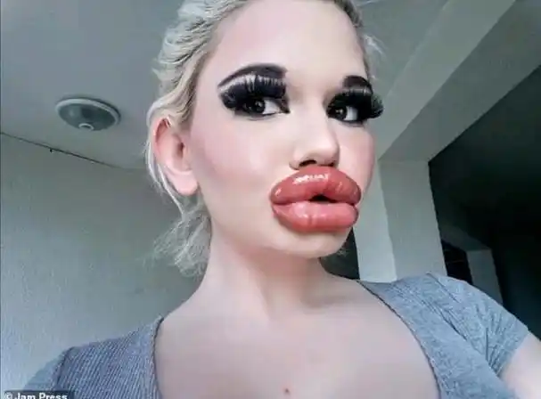 22岁少女迷恋丰唇无法自拔,已注射20次不满足,整容前是邻家小妹