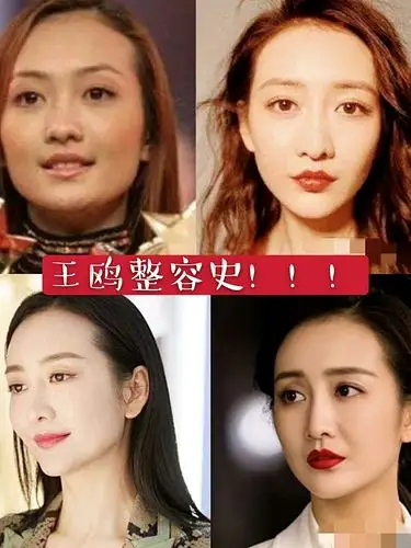 7979王鸥是不是整容过