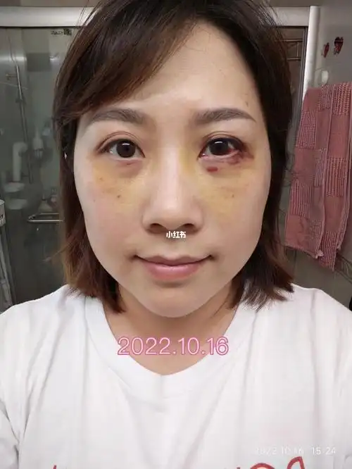 内切眼袋填泪沟第五第六天