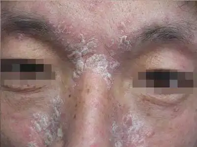 面部银屑病怎么治比较好