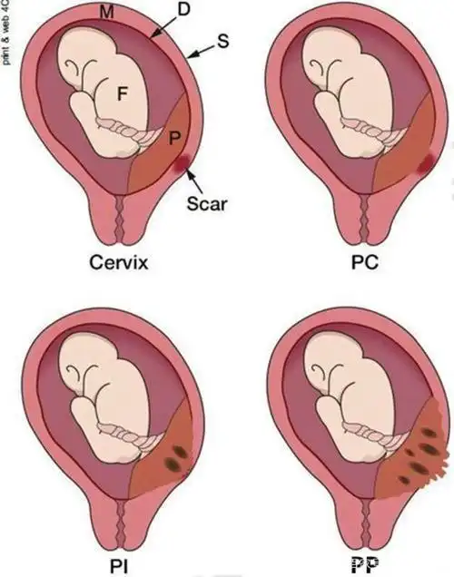 怀孕24周胎盘植入怎么办?专家:3点建议