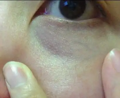 长了很多小疙瘩,不痛不痒没有任何感觉,不确定是不是脂肪粒,该怎么