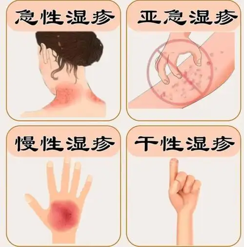 4种常见湿疹!别傻傻的连你是哪种都不知道