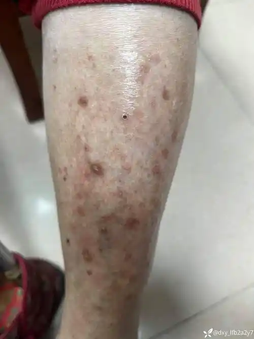 老人75岁皮肤瘙痒多年诊断