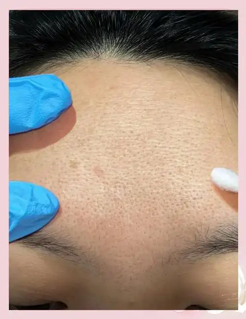 曾经的我,额头和脸颊被粗大的毛孔占据,皮肤粗糙得像砂纸,每天油腻