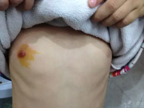 【求助】小女孩右侧乳头异常