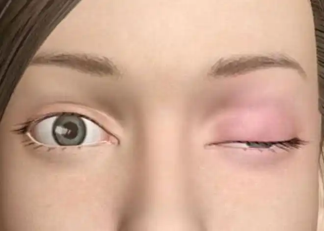 眼皮下垂是怎么回事这些原因让人很无力