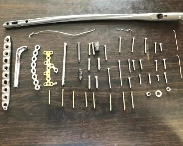 怎么取小数点后一位手术后身体里的钉子需要取吗什么类型不需要听听