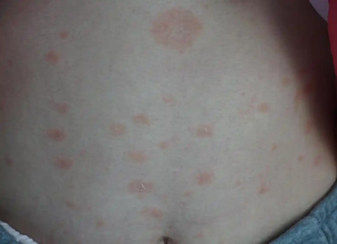 玫瑰糠疹,是说皮疹像玫瑰花一样的红色,实际上颜色不是那么鲜红;有