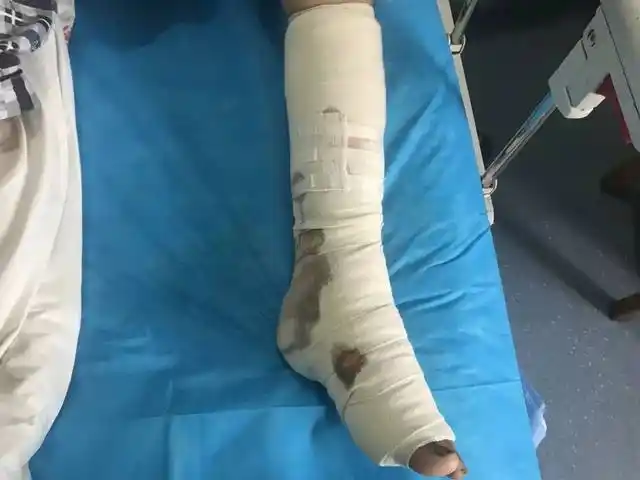 擦破黄豆大点皮,湖南一男子差点截肢
