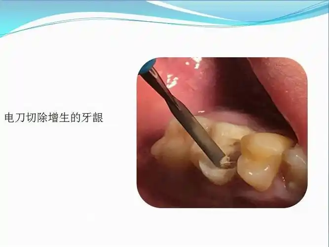 上颌第一恒磨牙dbmbmb2弯曲根管一次性根管治疗及数字化冠修复第三届