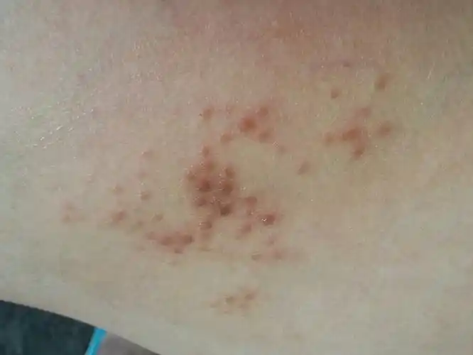 分享到:  今天 09:06 网友采纳 你这个应该不是痘痘,可能是热毒之类