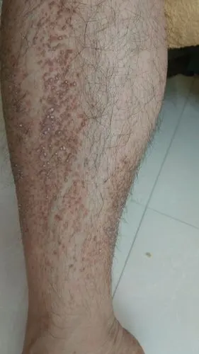 小腿上的皮肤问题,求专家解答!