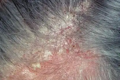 脂溢性皮炎图片