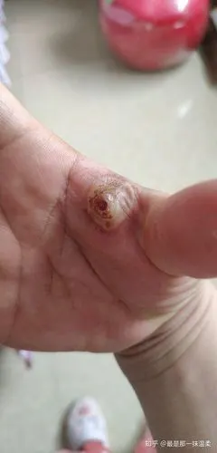 化脓性肉芽肿 - 知乎