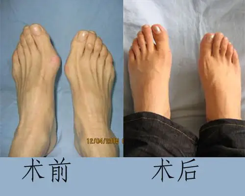 我院治疗拇外翻的特色之一,无痛苦,出血少,切口小,恢复快,手术时间短