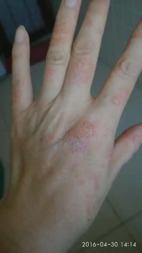 发表了博文《湿疹【续】》手上涂的是生姜粉.患者说,不痒了,快好了.