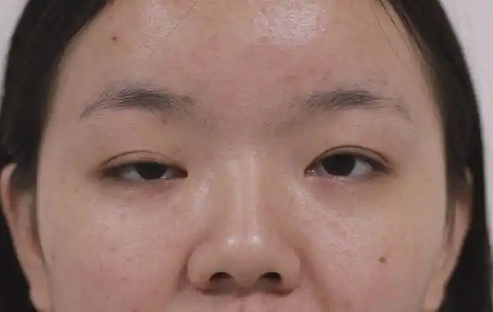 你真的是上睑下垂吗,上睑下垂是否需要治疗