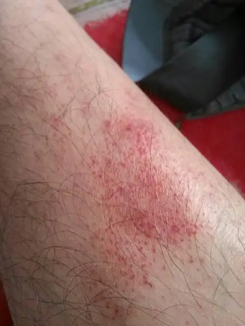 右小腿中部出现许多红点,不痛不痒,有半年多了,最近发现左腿以及臀部