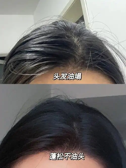 根头发扁塌出油说no74