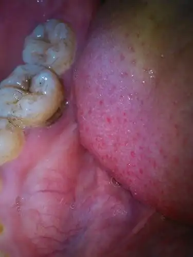 发现牙齿蛀牙,感觉牙齿不舒服有点痛怎么办