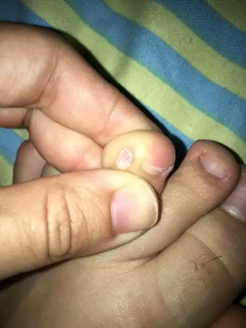 请问我脚上长了一个莫名其妙的肉刺,想问问知情人士能否告知我这是什