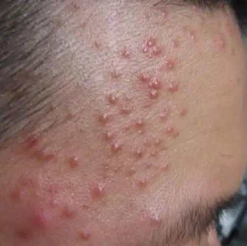 汗出过多,真菌感染,皮肤易得毛囊炎