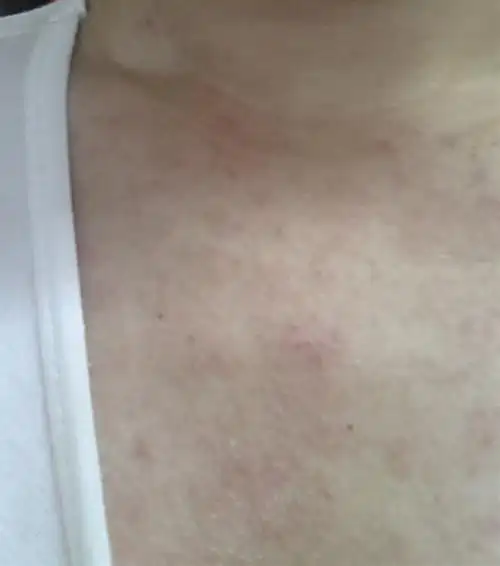 胸口有大片红疙瘩怎么办?