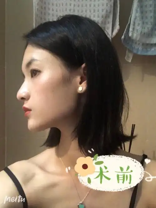 其实原本我的脸不是很大,就是因为下颌角非常突出,使得我整个面部"