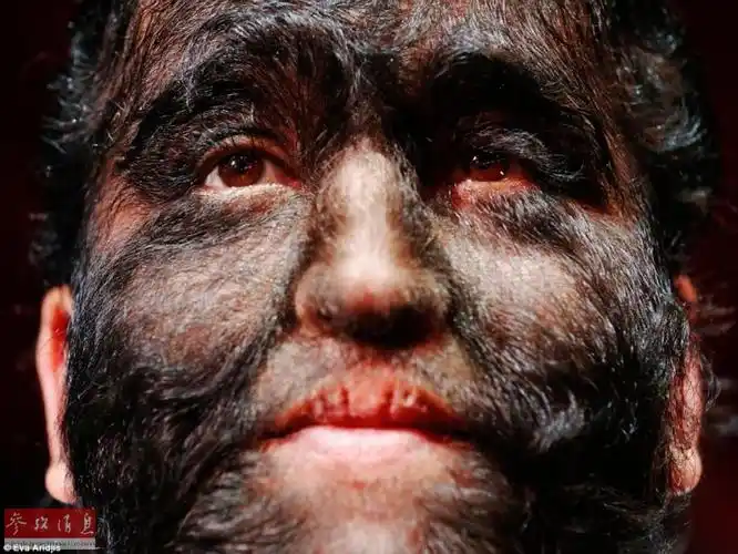 滚动新闻   编辑:肖芬 关键词:多毛症;遗传;毛发