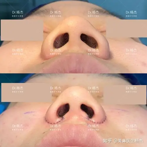 内外联合鼻翼缩小