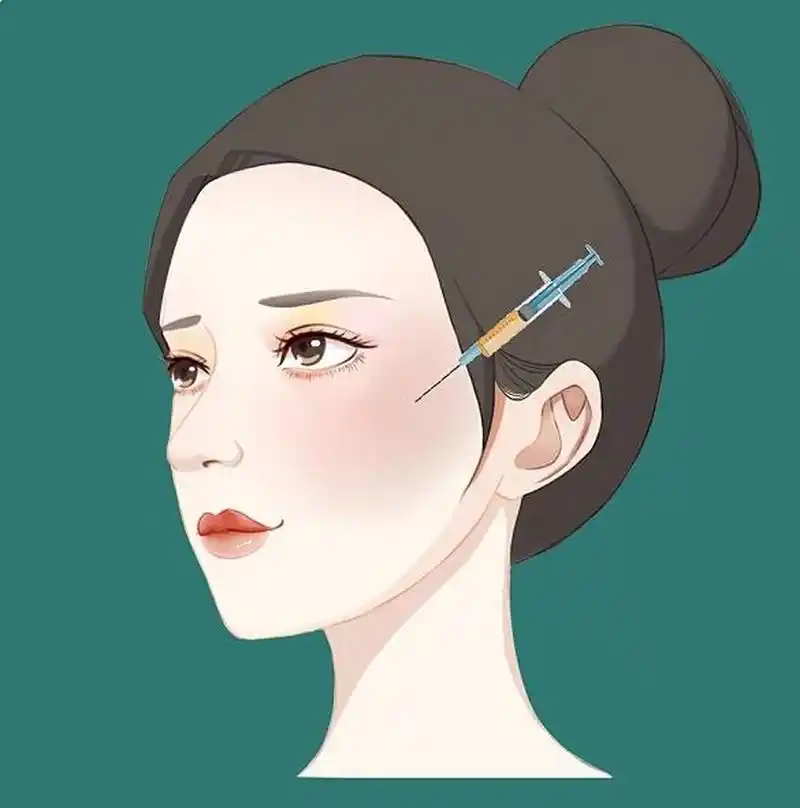 今日科普:全脸脂肪填充包括哪些部位❓,另外面部填充抽哪里的脂肪