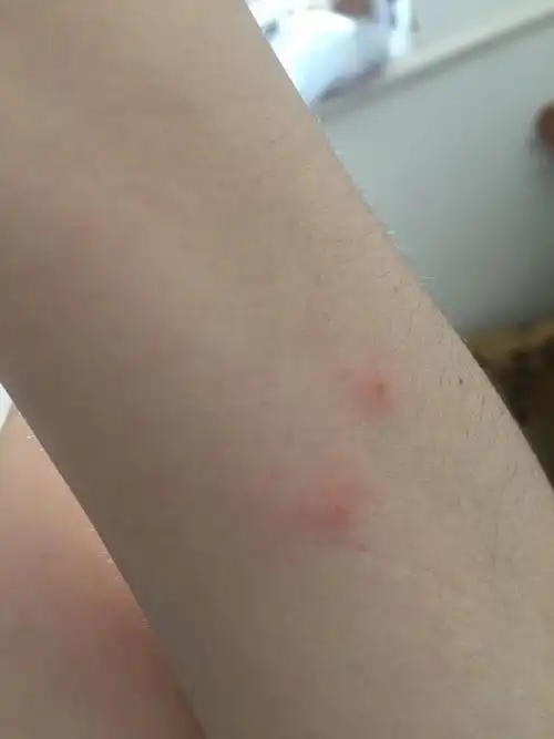 身上长了像蚊子咬的包每晚都会冒34个很痒遍布全身为什么