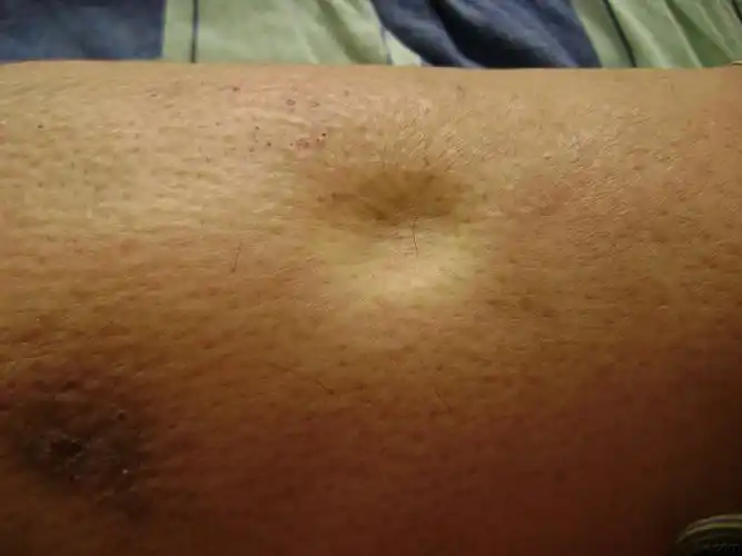 大家谁见过橡皮腿丝虫病这个像不像我没见过