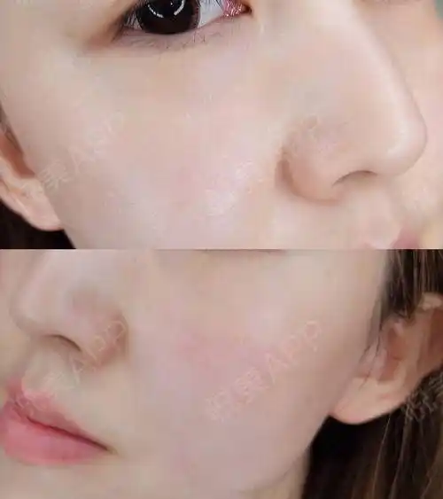 无针水光术后107天_超微小气泡术后107天_光子嫩肤术后107天_补水保湿