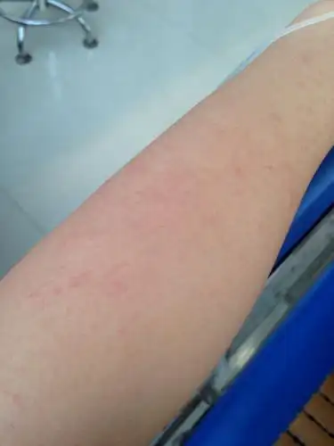 早上好像美女,骑电动车后手臂长了一些红红的,为什么,是太阳晒的吗