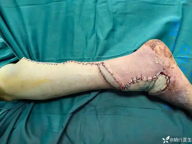 糖尿病患者电动车摔伤十小时就诊足部撕裂缝合完毕下地