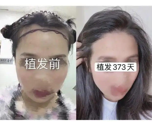 植发效果真实对比