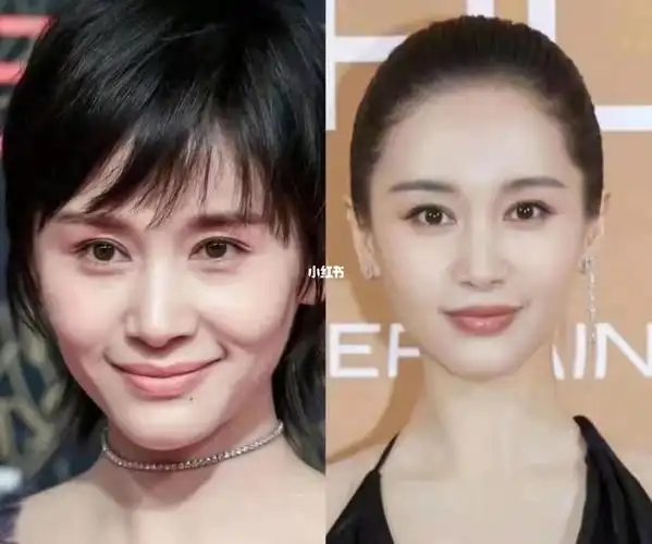 自体脂肪填充王子文美商真高_王子文_脂肪填充_美妆_医美整形