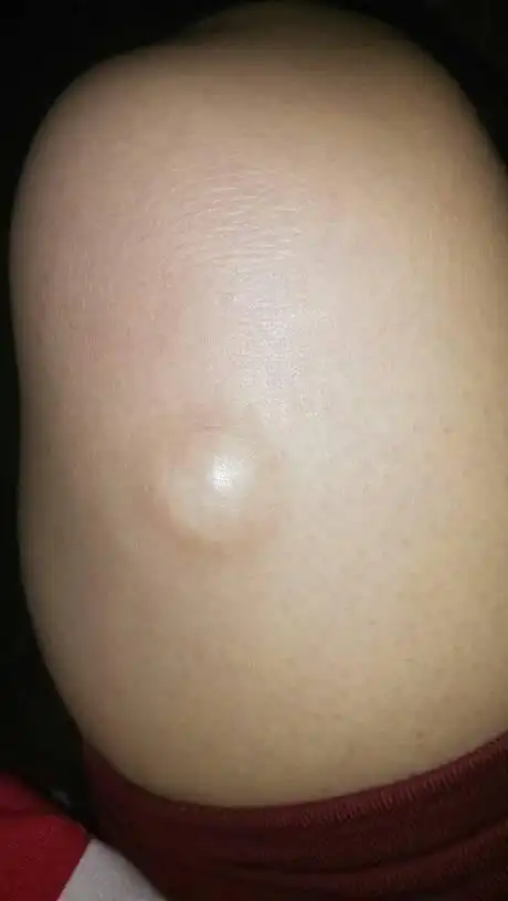 腿上长了这个疙瘩 压起来有点软,一边有点硬 压一