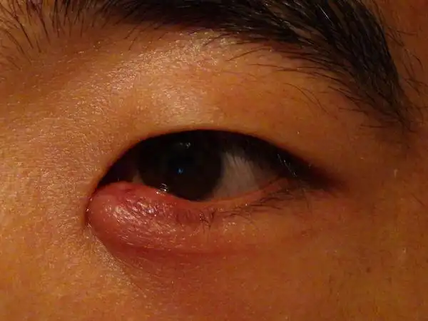 4号傍晚眼角有点痒,昨天稍微有点肿,今天