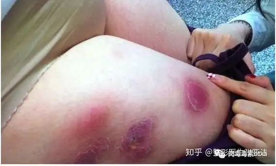 看了这个你还敢乱打溶脂针吗图片可能引起不适谨慎点开