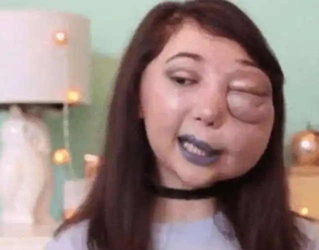 女子整容失败脸变形