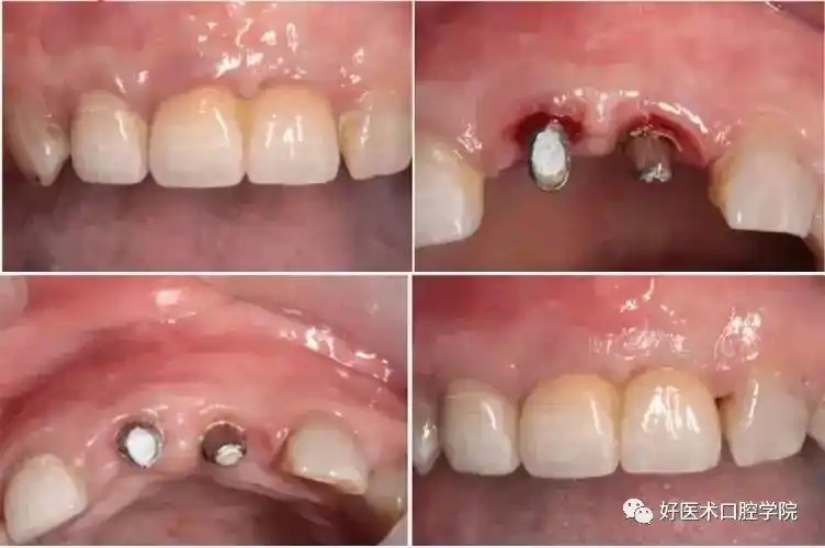 在种植体失败因素中,种植体生物学并发症具有一定影响意义.